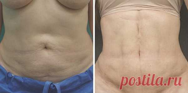 Домашнее средство избавит вас от жира на животе за 7 процедур + похудение до -4 кг. | Подслушано у диетолога | Яндекс Дзен