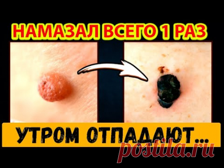 Запомни ЭТОТ Метод! Врачи Именно ТАК растворяют  бородавки и папилломы в домашних условиях …