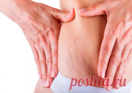 Как избавиться от растяжек на бедрах и попе натуральными средствами дома Как убрать растяжки на бедрах, попе и животе после родов натуральными средствами в домашних условиях. Как уменьшить растяжки на коже или избавиться вовсе.