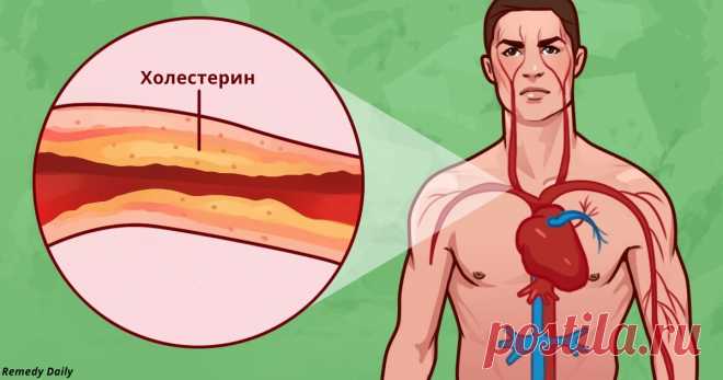 8 удивительных способов борьбы с холестерином и давлением Все четко.