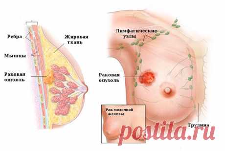 Рак молочной железы: симптомы, диагностика, лечение