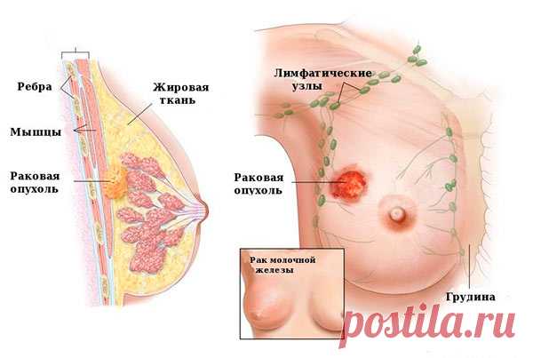 Рак молочной железы: симптомы, диагностика, лечение