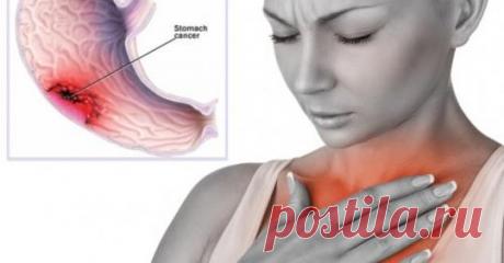 Хроническая изжога и кислотный рефлюкс могут быть ранними признаками рака. Вот, что вам нужно знать - Журнал для женщин