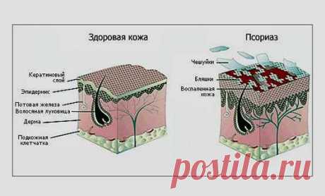 Что такое псориаз и от чего он появляется. Псориаз что это такое. Факторы повышающие риск заболеть псориазом. Виды, формы, стадии псориаза. Образ жизни при псориазе. Заболевание
