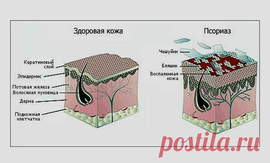 Что такое псориаз и от чего он появляется. Псориаз что это такое. Факторы повышающие риск заболеть псориазом. Виды, формы, стадии псориаза. Образ жизни при псориазе. Заболевание