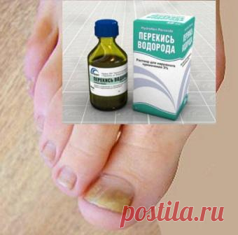 Лечение грибка ногтя в запущенной форме перекисью водорода  Описание и видео лечения перекисью водорода грибка ногтя в запущенной форме. Признаки заболевания, диета. Как лечить болезнь в самом начале