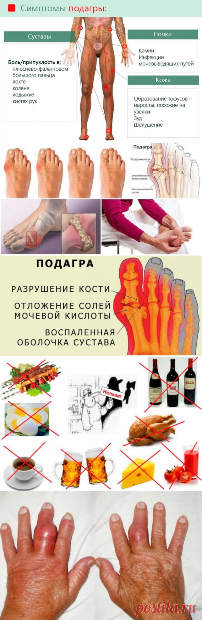 Симптомы подагры: современные методы и способы лечения