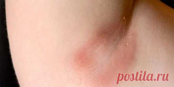 Грибок подмышек - почему появляется у ребенка или взрослого и как лечить покраснение, шелушение, зуд кожи Грибок подмышек развивается на фоне разных причин, принося с собой понижение качества жизни человека. Узнайте, каковы симптомы развития грибковой инфекции, как ее можно вылечить.