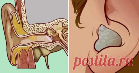 Отложите ватную палочку. Вот 8 безопасных и простых способов удалить скопление ушной серы — ХОЗЯЮШКА