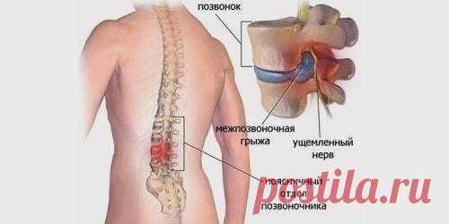 Поясничная грыжа лечится народными средствами