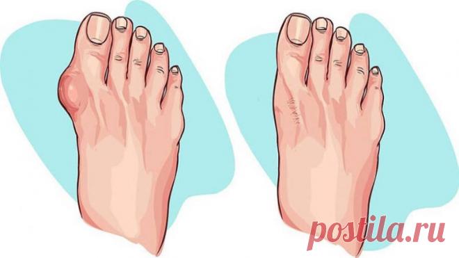 5 remedios para los juanetes en las piernas / Mantente saludable