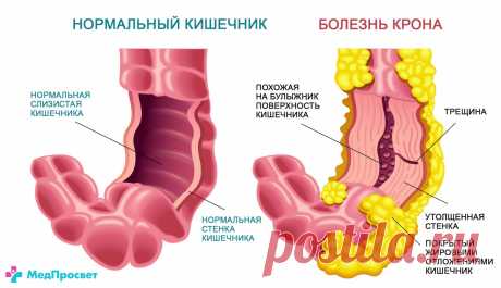 Болезнь Крона - симптомы, диагностика и лечение | Медицинский центр - МедПросвет
