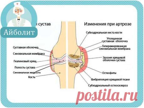 Пусть артроз н / Абсолютное здоровье
