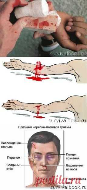 Кровотечение. Черепно-мозговая травма. Шок. | Книга выживания. Выживание в экстремальных условиях