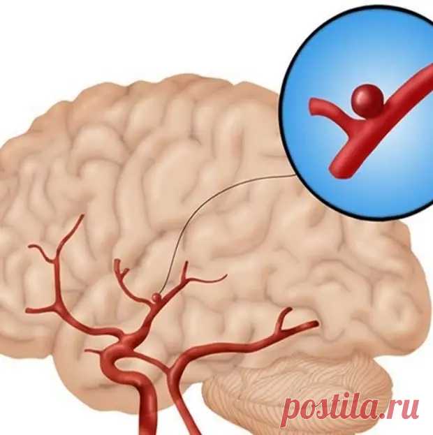7 признаков инсульта