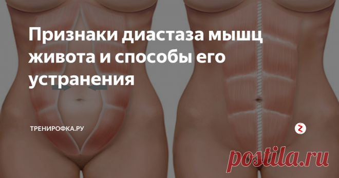 Признаки диастаза мышц живота и способы его устранения Среди наиболее распространенных патологий мышц брюшного пресса, которые встречаются у представителей как женской, так и мужской части населения, можно выделить диастаз прямых мышц живота. Особенно такое патологическое отклонение можно считать актуальным для перинатального периода, потому и диагностируется преимущественно у женщин после родоразрешения. Согласно статистическим данным, 40% недавно ст
