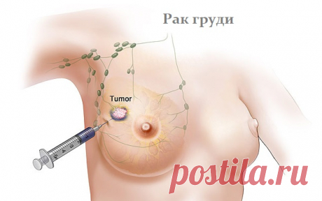 Лучшие суперпродукты, которые помогают бороться с раком молочной железы!  
 

Женщины, не игнорируйте!
 
Всемирная организация здравоохранения предсказала, что к 2020 году заболеваемость случаями рака молочной железы будет выше, чем сегодня. Считается, что риск развития ра…