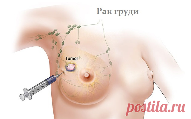 Лучшие суперпродукты, которые помогают бороться с раком молочной железы!  
 

Женщины, не игнорируйте!
 
Всемирная организация здравоохранения предсказала, что к 2020 году заболеваемость случаями рака молочной железы будет выше, чем сегодня. Считается, что риск развития ра…