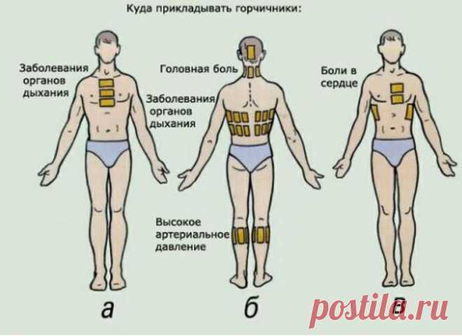 Горчичники. Горчичники вызывают приток крови к поражeнному участку за счeт раздражения кожных покровов. Горчичники используют не только при простудных заболеваниях, но и при различных мышечных повреждениях, растяжениях, при обострении ревматизма. Горчичники нельзя ставить при высокой температуре и держать на коже дольше 20 минут.