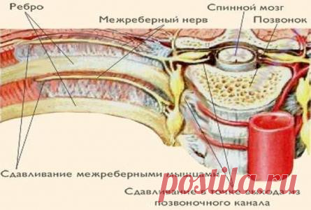 Межреберная невралгия: симптомы, причины, лечение