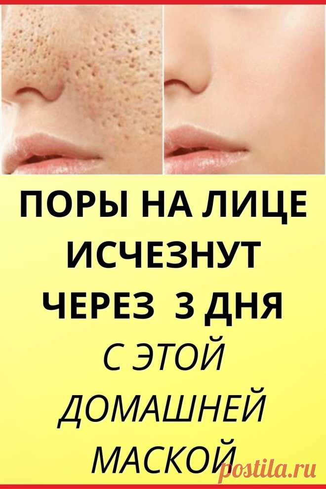 Поры на лице исчезнут через 3 дня, если вы будете применять одну из 4-х эффективных масок! 4 природных рецепта