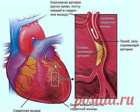 ПЕРВЫЕ ПРИЗНАКИ ТРОМБОЗА И ЕГО ПРОФИЛАКТИКА.