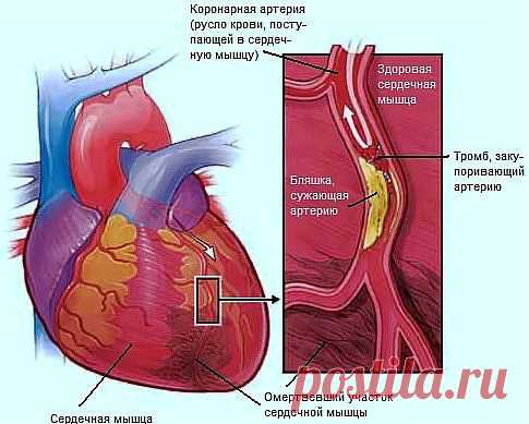 ПЕРВЫЕ ПРИЗНАКИ ТРОМБОЗА И ЕГО ПРОФИЛАКТИКА.