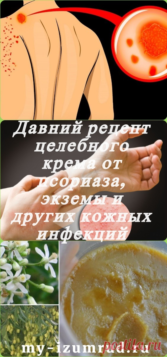 Давний рецепт целебного крема от псориаза, экземы и других кожных инфекций - My izumrud