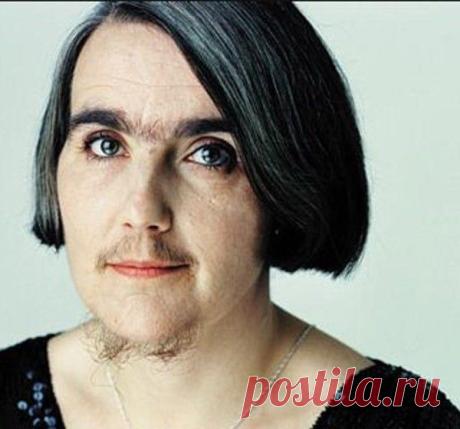 Гирсутизм: у женщин, причины, лечение, классификация, симптомы, осложнения, диагностика