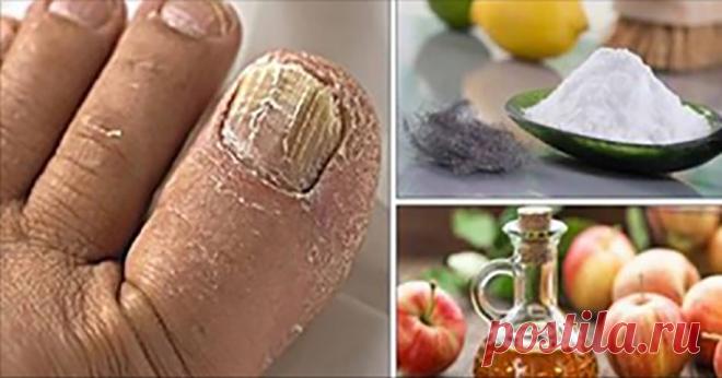 Лучшие домашние средства для удаления грибков ногтей! - Журнал для женщин Воспользуйтесь советом при необходимости! Одной из наиболее распространенных инфекций в наши дни, безусловно, является грибковая инфекция на пальцах ног. Он начинает казаться белым или желтым пятном под кончиком ногтя. Он выглядит совершенно безвредным, но с углублением инфекции ноготь становится очень толстым, желтым и начинает рушиться. Если вы оставите его необработанным, это затронет несколько других ногтей. […]