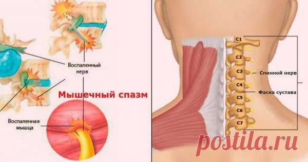 Мышечные зажимы шеи и спины: избавилась раз и навсегда! — Копилочка полезных советов