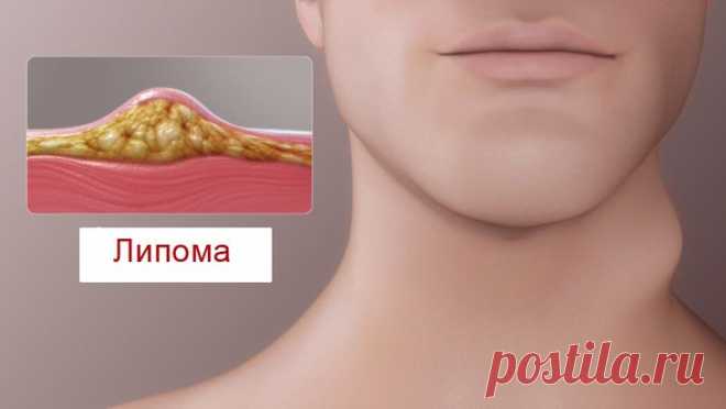 Липома (жировик): причины, симптомы и методы лечения