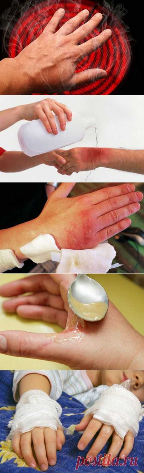 Ожог: экстренная помощь