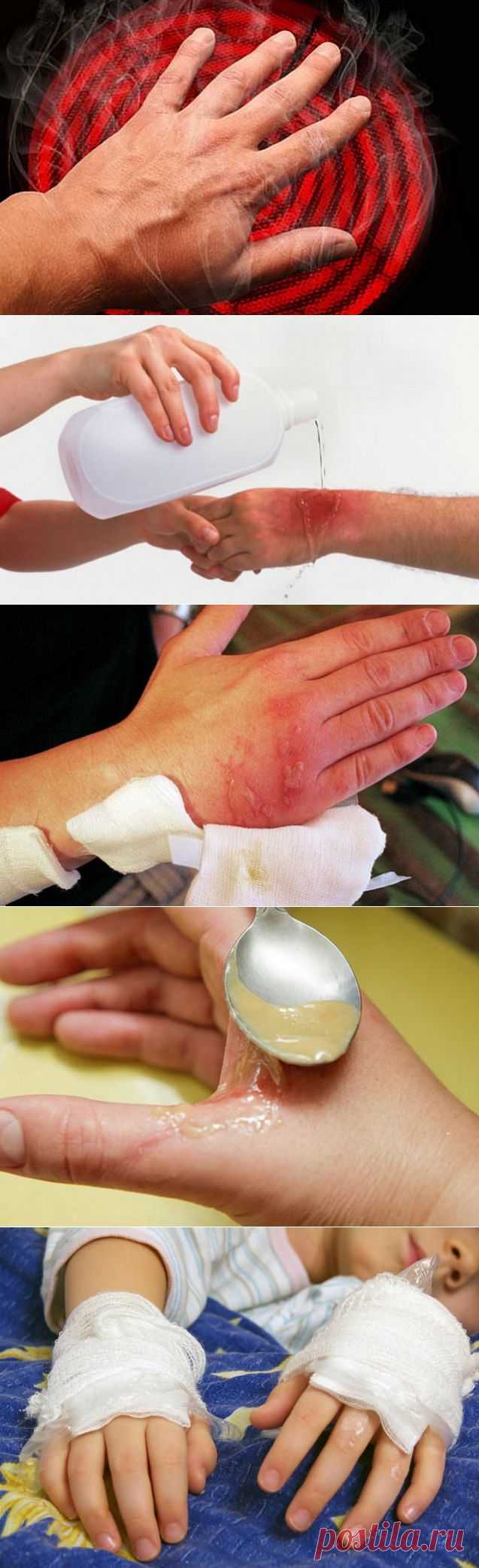 Ожог: экстренная помощь