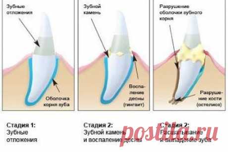 Народная медицина против пародонтоза | Мамам, женщинам, бабушкам и очень любознательным.
