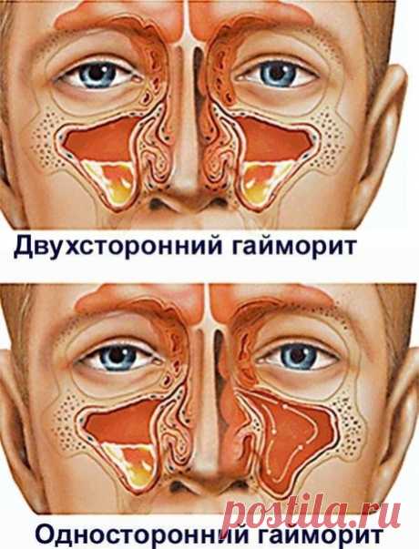 ГАЙМОРИТ

СОХРАНЯЙ себе, чтобы НЕ потерять.

Хронический гайморит можно вылечить обычным черным чаем с эвкалиптом.

Ингредиенты:
- одна чайная ложка меда,
- одна чайная ложка настойки эвкалипта (можно приобрести в аптеке), одна чайная ложка крепкой заварки черного чая.

Все ингредиенты перемешать и закапывать в нос три раза в сутки. Доза составляет приблизительно половину обычной пипетки.

Время лечения не менее трех дней. Однако облегчение наступает уже после двух-трех за...