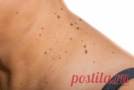 СРЕДСТВА И ТРАВЫ ПРИ ВИРУСЕ ПАПИЛЛОМЫ - ЭФФЕКТИВНЫЕ РЕЦЕПТЫ