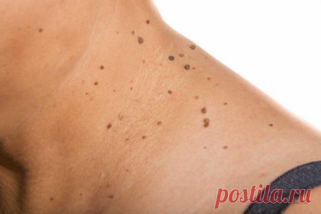 СРЕДСТВА И ТРАВЫ ПРИ ВИРУСЕ ПАПИЛЛОМЫ - ЭФФЕКТИВНЫЕ РЕЦЕПТЫ