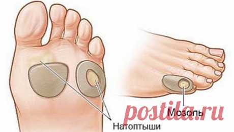 Как избавиться от натоптышей в домашних условиях