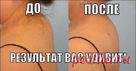 КАК ИЗБАВИТЬСЯ ОТ ХОЛКИ НА ШЕЕ! После нескольких процедур шея вновь станет гибкой и красивой! - Женский Журнал У многих женщин после 35-40 лет в области седьмого шейного позвонка часто появляется «холка» — жировые отложения у основания шеи. «Холка» способна сдавливать артерии, что может привести к гипоксии (нарушению кровоснабжения) головного мозга и воротниковой зоны. Чтобы ее убрать: Необходимо смешать в стакане 3 ст.л. оливкового масла и 1 сырое куриное яйцо, добавить столько же …