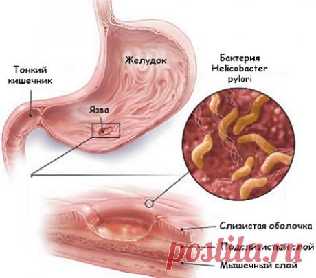 Гастрит, язва желудка, боль в желудке. Лечение народными средствами.