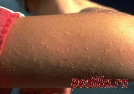 10 признаков того, что у вас непереносимость глютена - медиаплатформа МирТесен Более 55 болезней так или иначе связаны с глютеном – белком, содержащимся в пшенице, ржи и ячмене. И примерно 99% людей, страдающих непереносимостью глютена или целиакией, так и не ставят правильный диагноз. Исследования показывают, что примерно 15% населения развитых стран страдают