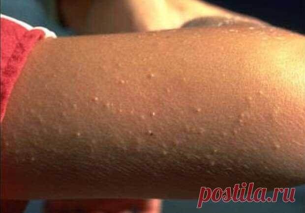 10 признаков того, что у вас непереносимость глютена - медиаплатформа МирТесен Более 55 болезней так или иначе связаны с глютеном – белком, содержащимся в пшенице, ржи и ячмене. И примерно 99% людей, страдающих непереносимостью глютена или целиакией, так и не ставят правильный диагноз. Исследования показывают, что примерно 15% населения развитых стран страдают