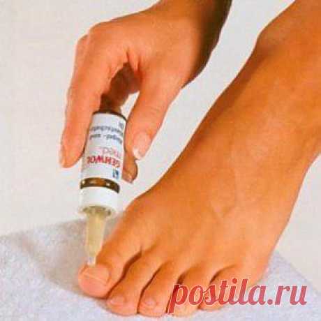 Лечение онихокриптоза (вросшего ногтя) | Maiden.com.ua