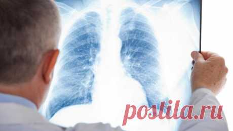 Фиброз легких: причины, симптомы, тактика лечения