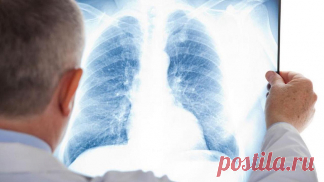 Фиброз легких: причины, симптомы, тактика лечения