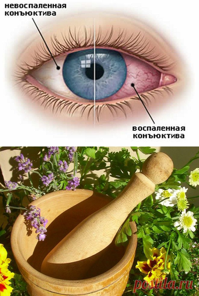 Как лечить коньюктивит в домашних условиях. | Народная медицина