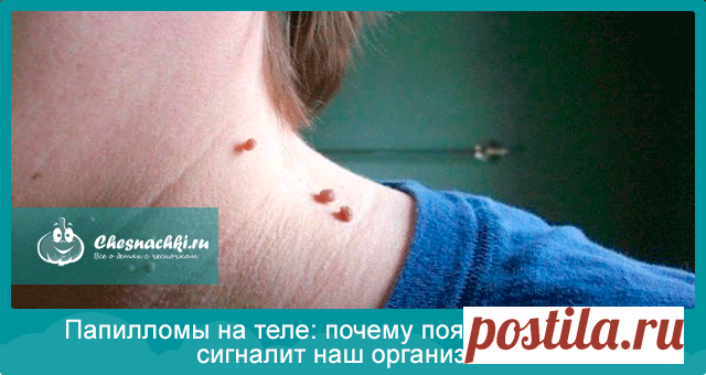Почему появляются папилломы на теле о чем сигналит организм?