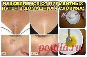 ИЗБАВЛЯЕМСЯ ОТ ПИГМЕНТНЫХ ПЯТЕН | Блог сайта Muza.Name