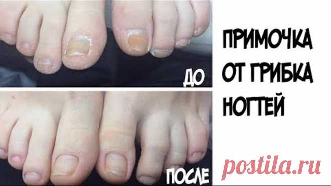 Как БЫСТРО избавиться от грибка ногтей в домашних условиях